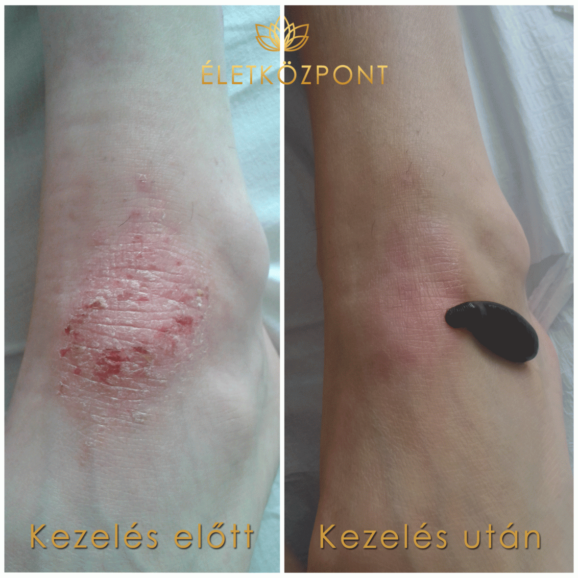 Piócaterápia az ÉletKözpontban! A pióca sok betegség kezelésére alkalmas. A piócaterápia vagy hirudoterápia előnye abban rejlik, hogy nem egy, hanem több betegséget lehet egyszerre kezelni, és nem a betegséget, hanem az egész szervezetet gyógyítja. 